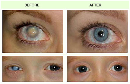 Contact Lenses | Nayandeep Eye Hospital