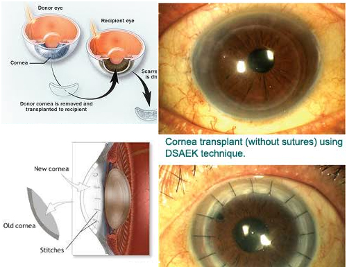 Cornea | Nayandeep Eye Hospital