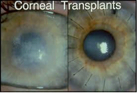 Cornea | Nayandeep Eye Hospital