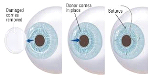 Cornea | Nayandeep Eye Hospital