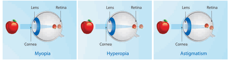 LASIK | Nayandeep Eye Hospital