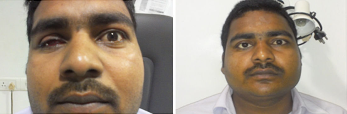 Ocular Prosthesis | Nayandeep Eye Hospital