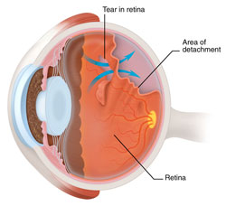 Retina Vitreous Service | Nayandeep Eye Hospital