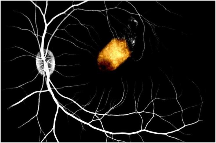 Scientists take important step toward using retinal cell transplants to treat blindness